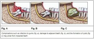 Common Problems Caused by Wisdom Teeth | Center City Emergency Dentist