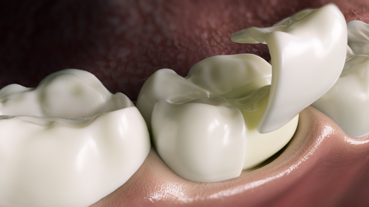 Are Inlays and Onlays Better Than Fillings?